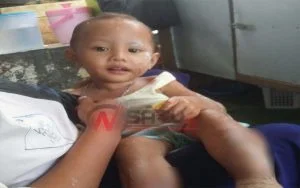 Tak Ada Biaya, Balita Penderita Kelainan Kulit Di Pamekasan Terus Melepuh