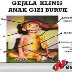 Dinkes Pamekasan Ingin Tuntaskan Masalah Gizi Buruk Melalui PIS-PK