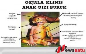Dinkes Pamekasan Ingin Tuntaskan Masalah Gizi Buruk Melalui PIS-PK
