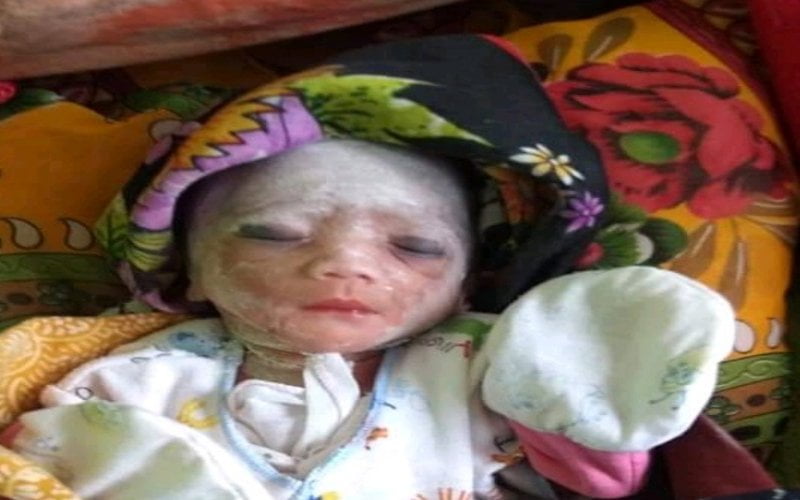 Dibuang di Pemakaman, Bayi Cacat Fisik Bikin Geger Warga Sumenep