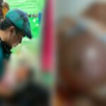 Lahir Tanpa Anus, Bayi di Camplong Memprihatinkan